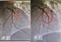 【生死時速 為生命護航】心梗患者感激送錦旗