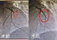 0401【生死時刻，全力以赴】武寧縣人民醫(yī)院成功搶救一名急性心肌梗死患者