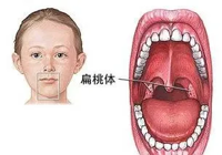 【健康科普】兒童扁桃體、腺樣體腫大，要手術(shù)嗎？